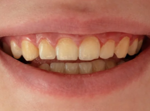 Smiling person displaying teeth with slight discoloration, emphasizing the importance of teeth whitening and oral care at Progressive Dental Care.