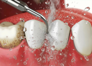 Dentist performing periodontal cleaning in South Portland, ME.