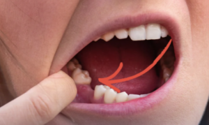 Missing tooth in the lower jaw highlighted for treatment with dental implants. Illustration of tooth loss and dental implant replacement options at Progressive Dental Care.