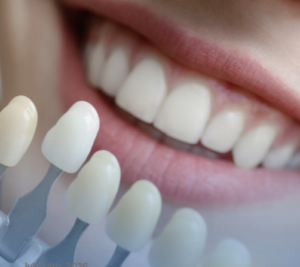 Professional teeth whitening shade guide for a brighter smile at Progressive Dental Care in South Portland, ME