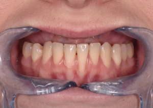 Patient showing early gum recession before periodontal cleaning at Progressive Dental Care in Scarborough, ME.