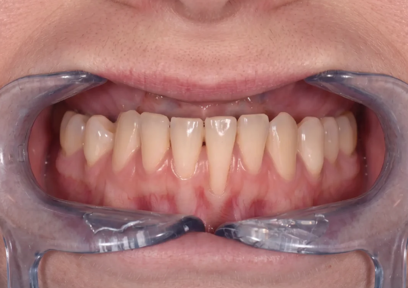 Patient showing early gum recession before periodontal cleaning at Progressive Dental Care in Scarborough, ME.
